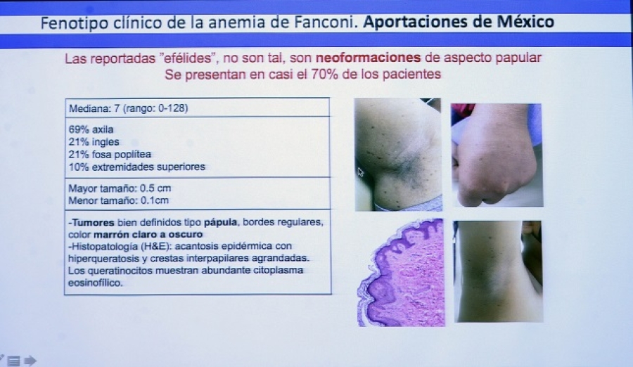 Contribuye la UNAM al diagnóstico temprano de enfermedad ultrarrara